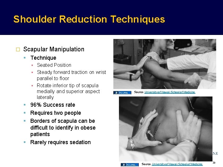 Shoulder Reduction Techniques � Scapular Manipulation Technique ▪ Seated Position ▪ Steady forward traction Shoulder Reduction Techniques � Scapular Manipulation Technique ▪ Seated Position ▪ Steady forward traction