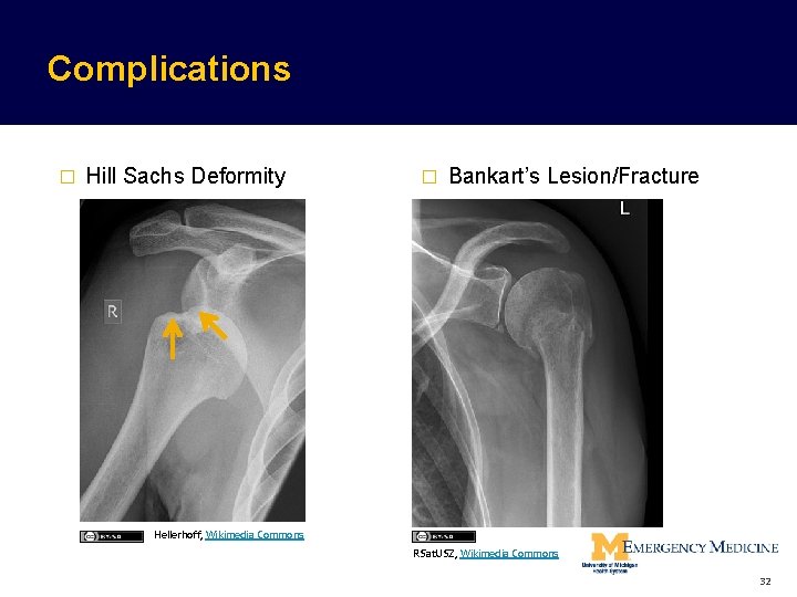 Complications � Hill Sachs Deformity Hellerhoff, Wikimedia Commons � Bankart’s Lesion/Fracture http: //www. mypacs. Complications � Hill Sachs Deformity Hellerhoff, Wikimedia Commons � Bankart’s Lesion/Fracture http: //www. mypacs.