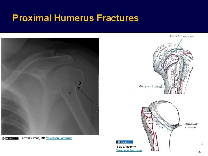 Proximal Humerus Fractures 1 3 2 James Heilman, MD, Wikimedia Commons Fragments of Humerus Proximal Humerus Fractures 1 3 2 James Heilman, MD, Wikimedia Commons Fragments of Humerus