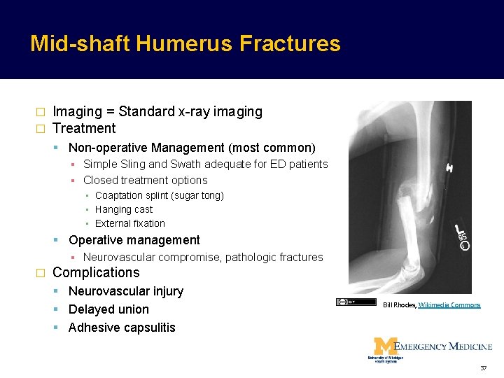 Mid-shaft Humerus Fractures � � Imaging = Standard x-ray imaging Treatment Non-operative Management (most Mid-shaft Humerus Fractures � � Imaging = Standard x-ray imaging Treatment Non-operative Management (most