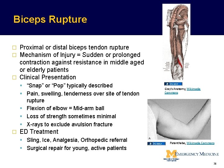 Biceps Rupture Proximal or distal biceps tendon rupture Mechanism of Injury = Sudden or Biceps Rupture Proximal or distal biceps tendon rupture Mechanism of Injury = Sudden or