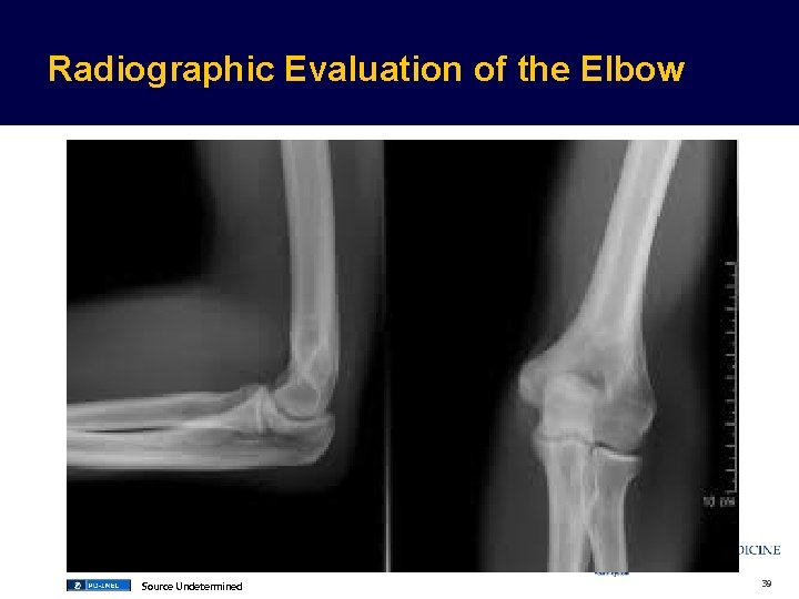 Radiographic Evaluation of the Elbow Source Undetermined 39  Radiographic Evaluation of the Elbow Source Undetermined 39
