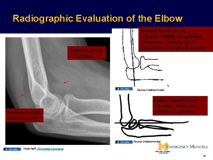 Radiographic Evaluation of the Elbow Anterior Fat Pad “Sail Sign” Anterior Humeral Line • Radiographic Evaluation of the Elbow Anterior Fat Pad “Sail Sign” Anterior Humeral Line •