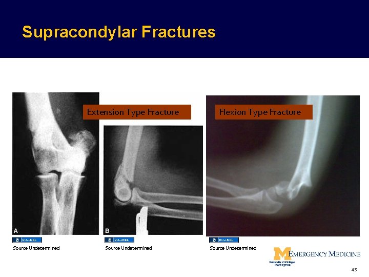 Supracondylar Fractures Extension Type Fracture Source Undetermined Flexion Type Fracture Source Undetermined 43  Supracondylar Fractures Extension Type Fracture Source Undetermined Flexion Type Fracture Source Undetermined 43