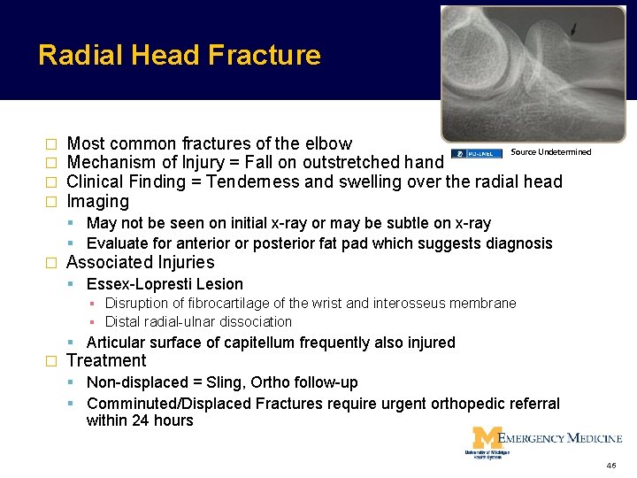 Radial Head Fracture � � Most common fractures of the elbow Source Undetermined Mechanism Radial Head Fracture � � Most common fractures of the elbow Source Undetermined Mechanism