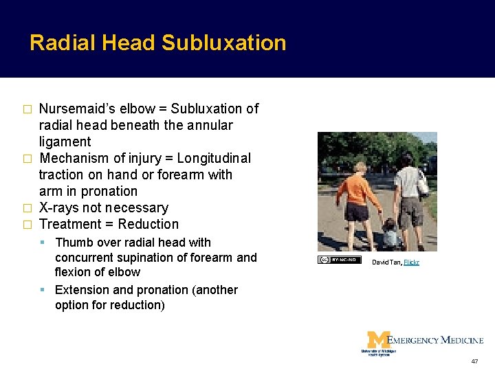 Radial Head Subluxation Nursemaid’s elbow = Subluxation of radial head beneath the annular ligament Radial Head Subluxation Nursemaid’s elbow = Subluxation of radial head beneath the annular ligament