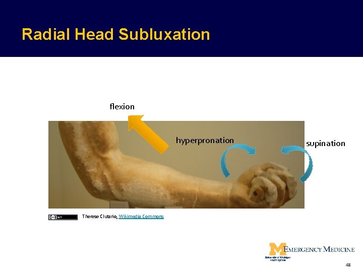 Radial Head Subluxation flexion hyperpronation supination Therese Clutario, Wikimedia Commons 48  Radial Head Subluxation flexion hyperpronation supination Therese Clutario, Wikimedia Commons 48