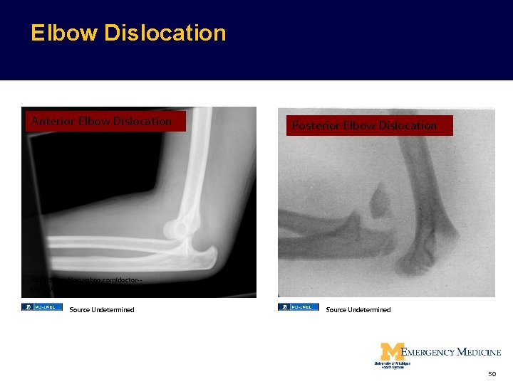 Elbow Dislocation Anterior Elbow Dislocation Posterior Elbow Dislocation http: //tw. myblog. yahoo. com/doctor-anjenli/article? mid=776&prev=778&next=774&l=f&fid=79 Elbow Dislocation Anterior Elbow Dislocation Posterior Elbow Dislocation http: //tw. myblog. yahoo. com/doctor-anjenli/article? mid=776&prev=778&next=774&l=f&fid=79
