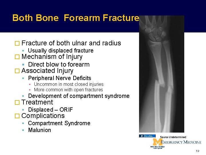 Both Bone Forearm Fracture � Fracture of both ulnar and radius Usually displaced fracture Both Bone Forearm Fracture � Fracture of both ulnar and radius Usually displaced fracture
