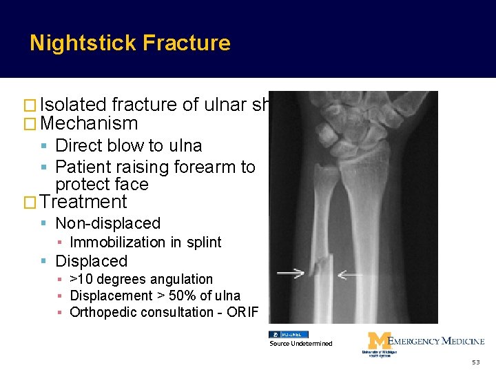 Nightstick Fracture � Isolated fracture of ulnar shaft � Mechanism Direct blow to ulna Nightstick Fracture � Isolated fracture of ulnar shaft � Mechanism Direct blow to ulna
