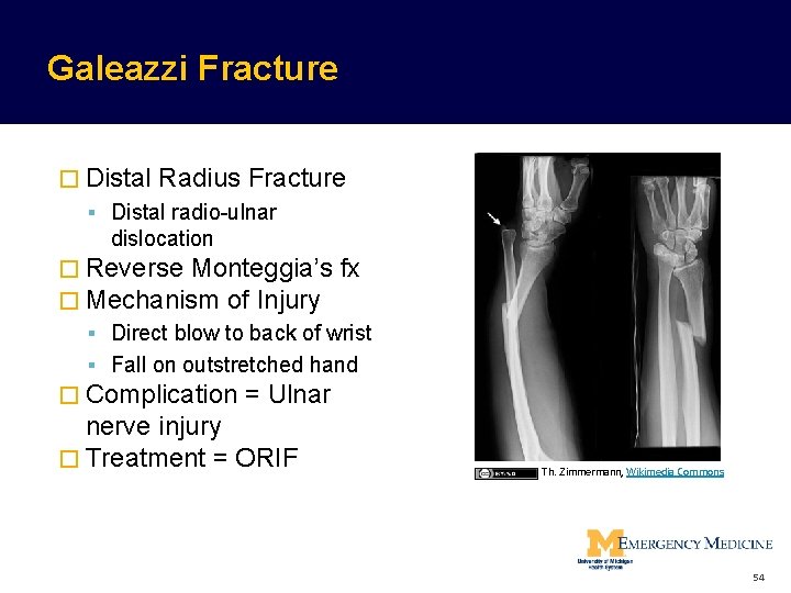 Galeazzi Fracture � Distal Radius Fracture Distal radio-ulnar dislocation � Reverse Monteggia’s fx � Galeazzi Fracture � Distal Radius Fracture Distal radio-ulnar dislocation � Reverse Monteggia’s fx �