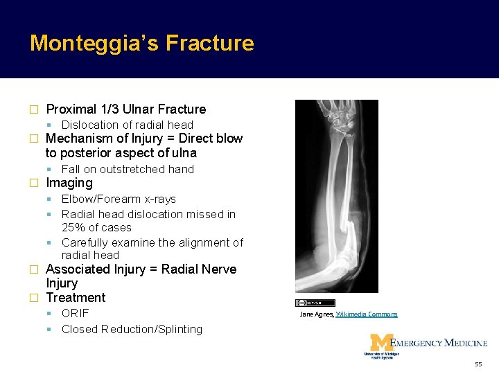 Monteggia’s Fracture � Proximal 1/3 Ulnar Fracture Dislocation of radial head � Mechanism of Monteggia’s Fracture � Proximal 1/3 Ulnar Fracture Dislocation of radial head � Mechanism of