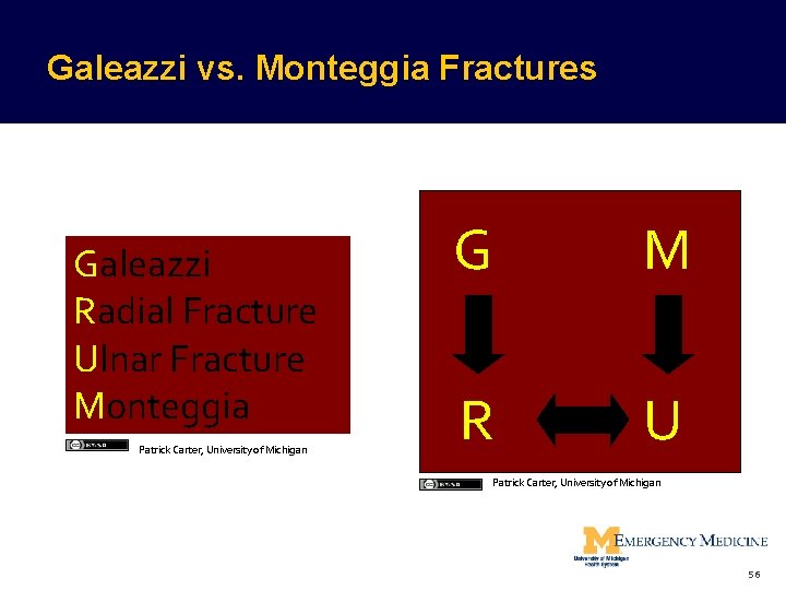 Galeazzi vs. Monteggia Fractures Galeazzi Radial Fracture Ulnar Fracture Monteggia Patrick Carter, University of Galeazzi vs. Monteggia Fractures Galeazzi Radial Fracture Ulnar Fracture Monteggia Patrick Carter, University of