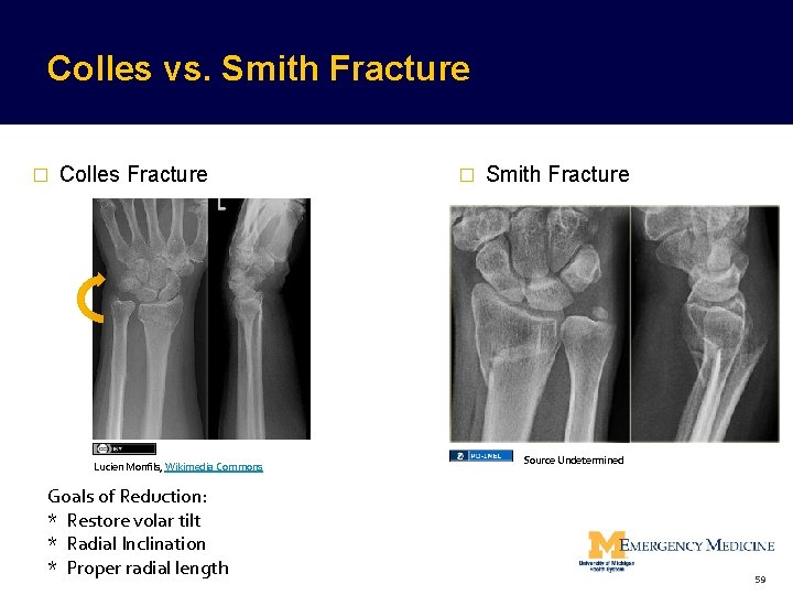 Colles vs. Smith Fracture � Colles Fracture Lucien Monfils, Wikimedia Commons Goals of Reduction: Colles vs. Smith Fracture � Colles Fracture Lucien Monfils, Wikimedia Commons Goals of Reduction: