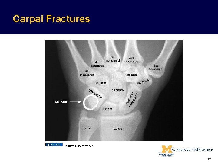 Carpal Fractures Source Undetermined 60  Carpal Fractures Source Undetermined 60