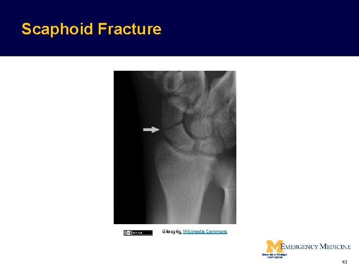 Scaphoid Fracture Gilo 1969, Wikimedia Commons 62  Scaphoid Fracture Gilo 1969, Wikimedia Commons 62
