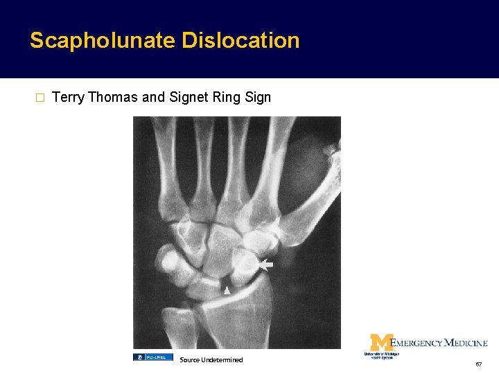 Scapholunate Dislocation � Terry Thomas and Signet Ring Sign Source Undetermined 67  Scapholunate Dislocation � Terry Thomas and Signet Ring Sign Source Undetermined 67
