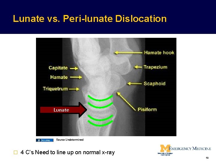 Lunate vs. Peri-lunate Dislocation Lunate Source Undetermined � 4 C’s Need to line up Lunate vs. Peri-lunate Dislocation Lunate Source Undetermined � 4 C’s Need to line up