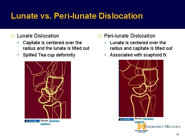 Lunate vs. Peri-lunate Dislocation � Lunate Dislocation � Peri-lunate Dislocation Capitate is centered over Lunate vs. Peri-lunate Dislocation � Lunate Dislocation � Peri-lunate Dislocation Capitate is centered over