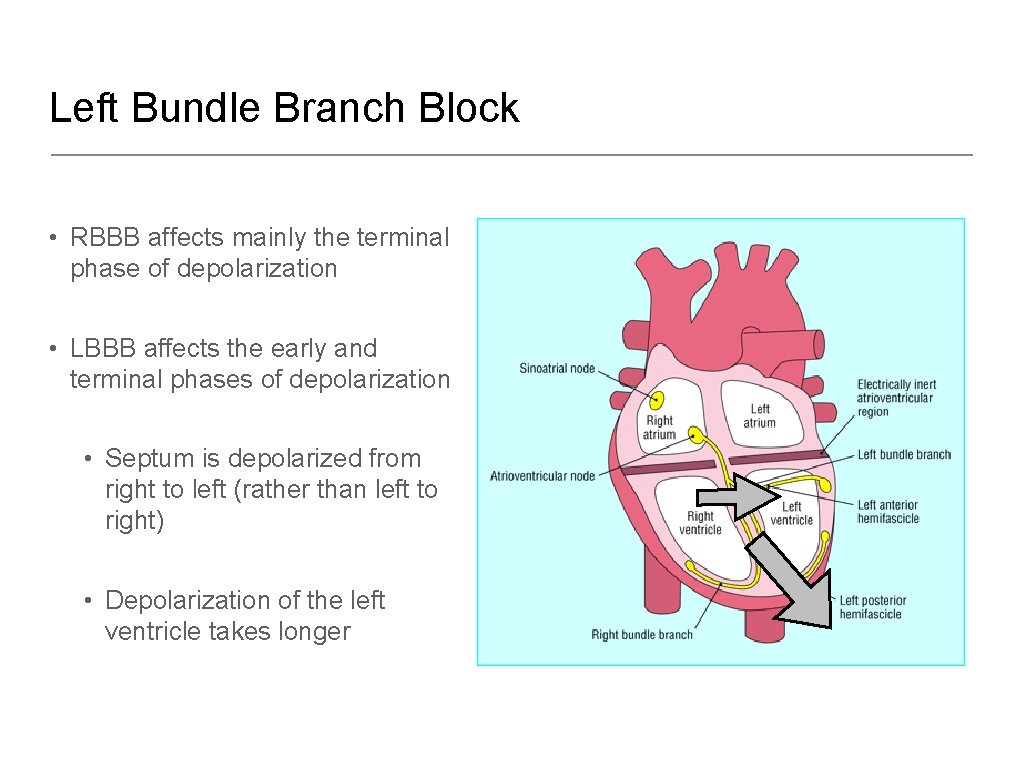 Left Bundle Branch Block • RBBB affects mainly the terminal phase of depolarization •