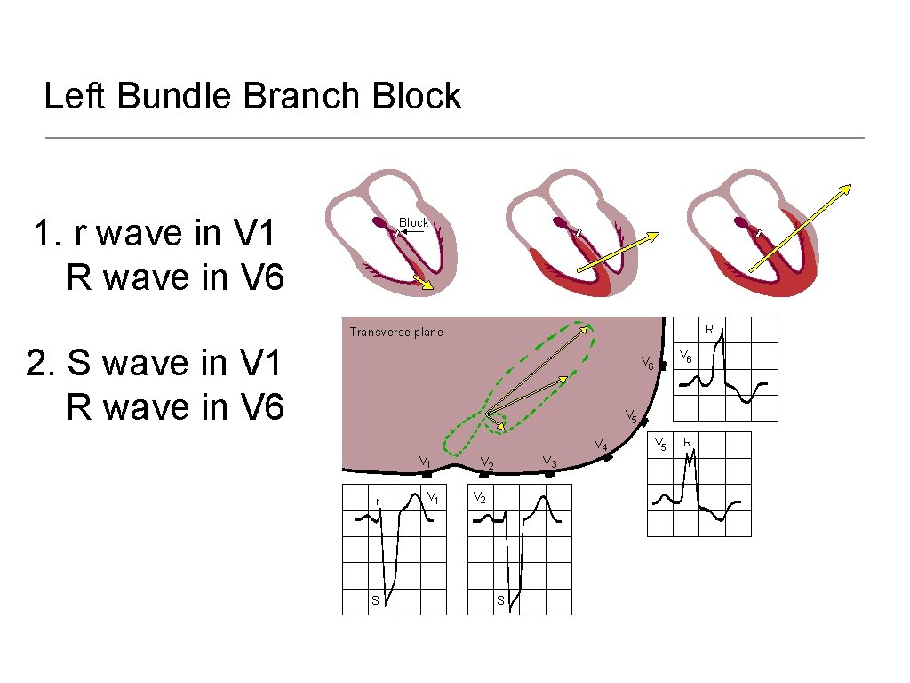 Left Bundle Branch Block 1. r wave in V 1 R wave in V