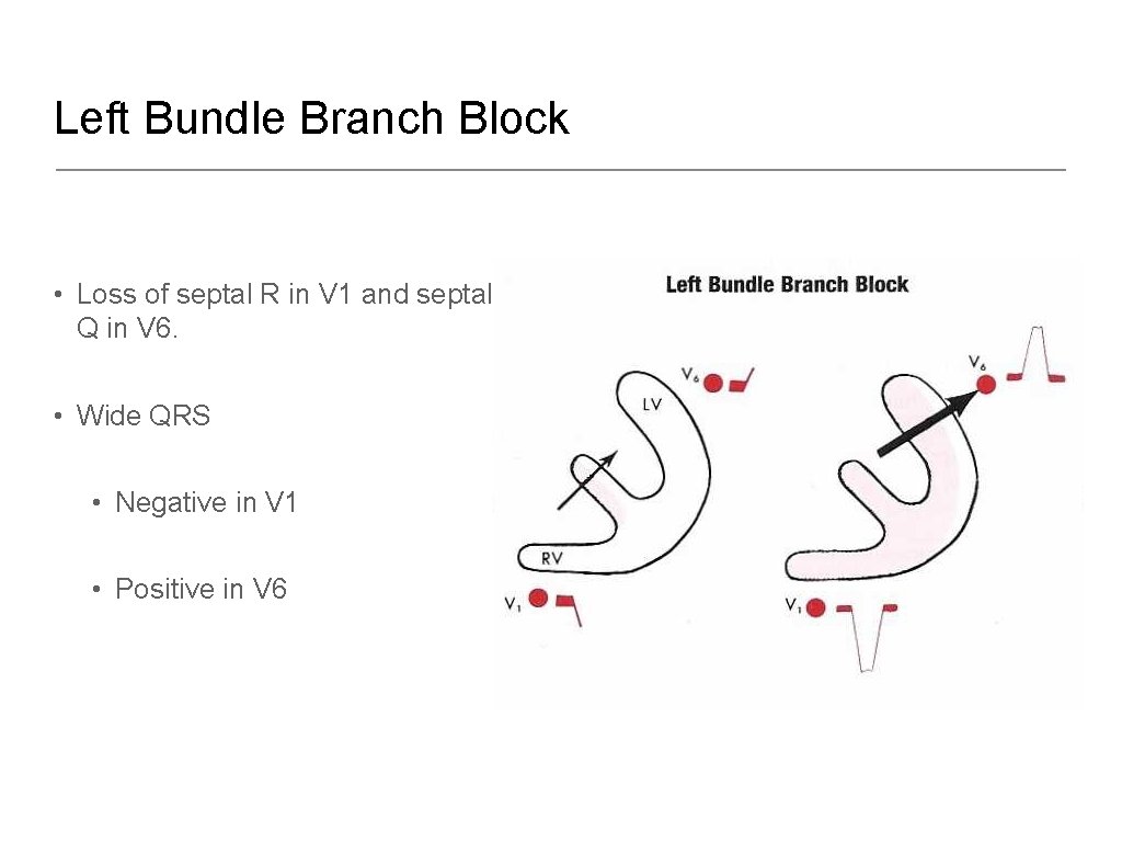 Left Bundle Branch Block • Loss of septal R in V 1 and septal