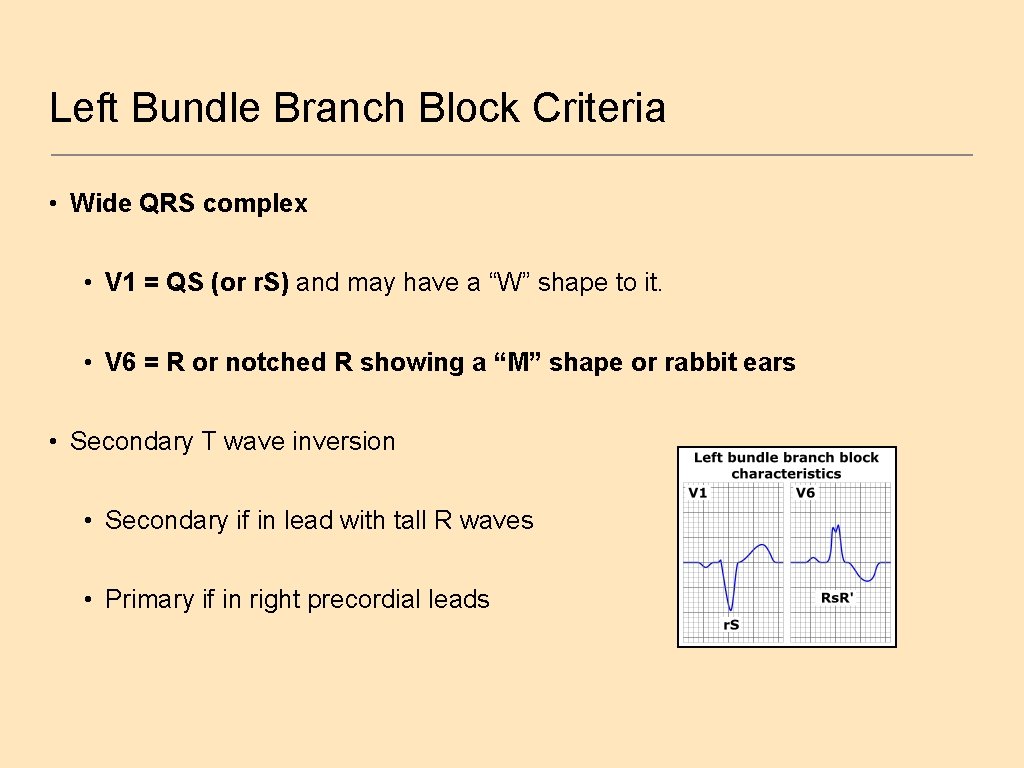 Left Bundle Branch Block Criteria • Wide QRS complex • V 1 = QS