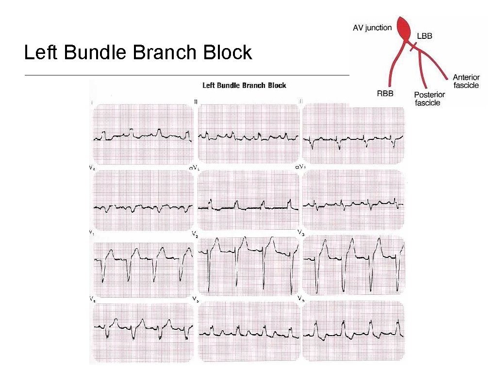 Left Bundle Branch Block 