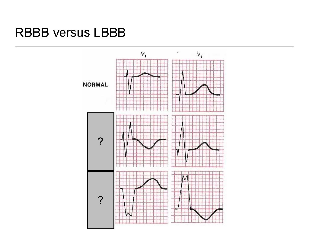 RBBB versus LBBB ? ? 