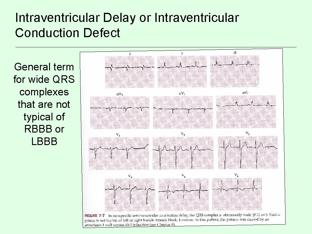 Intraventricular Delay or Intraventricular Conduction Defect General term for wide QRS complexes that are