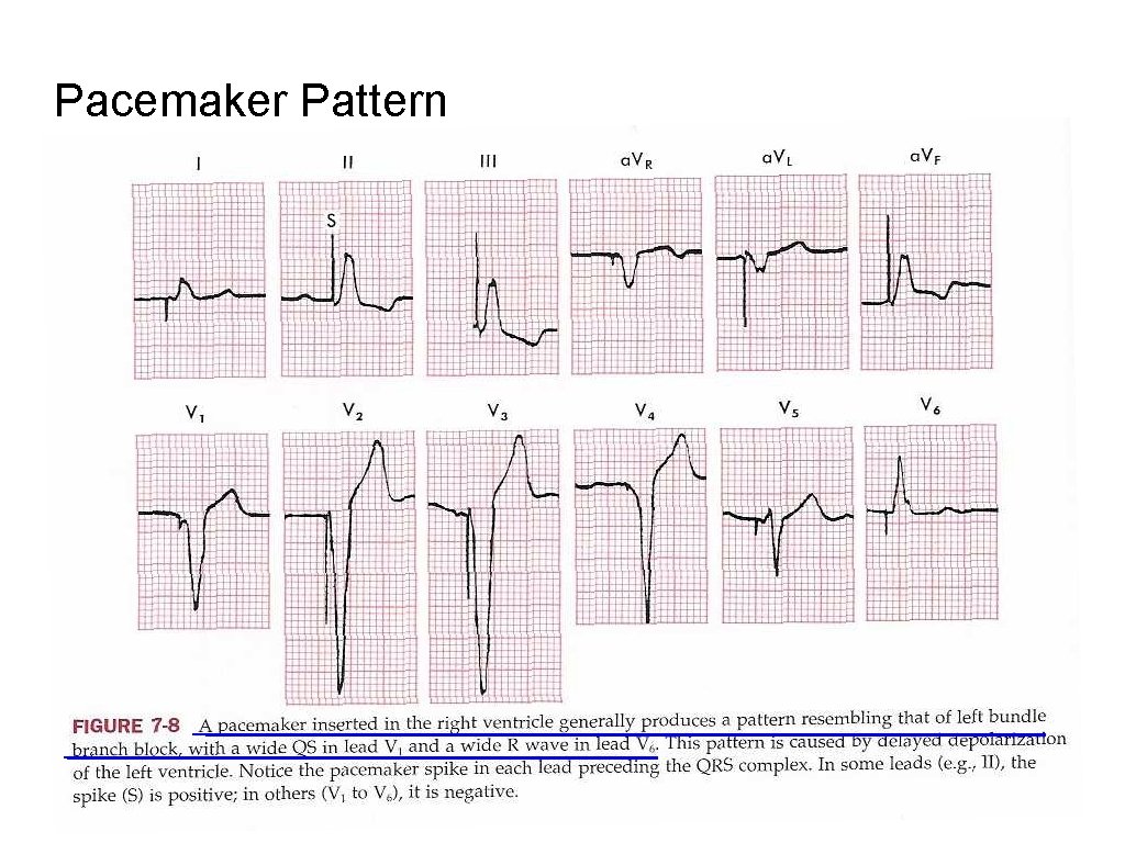 Pacemaker Pattern 