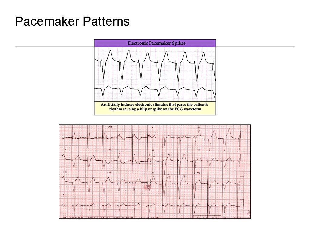 Pacemaker Patterns 