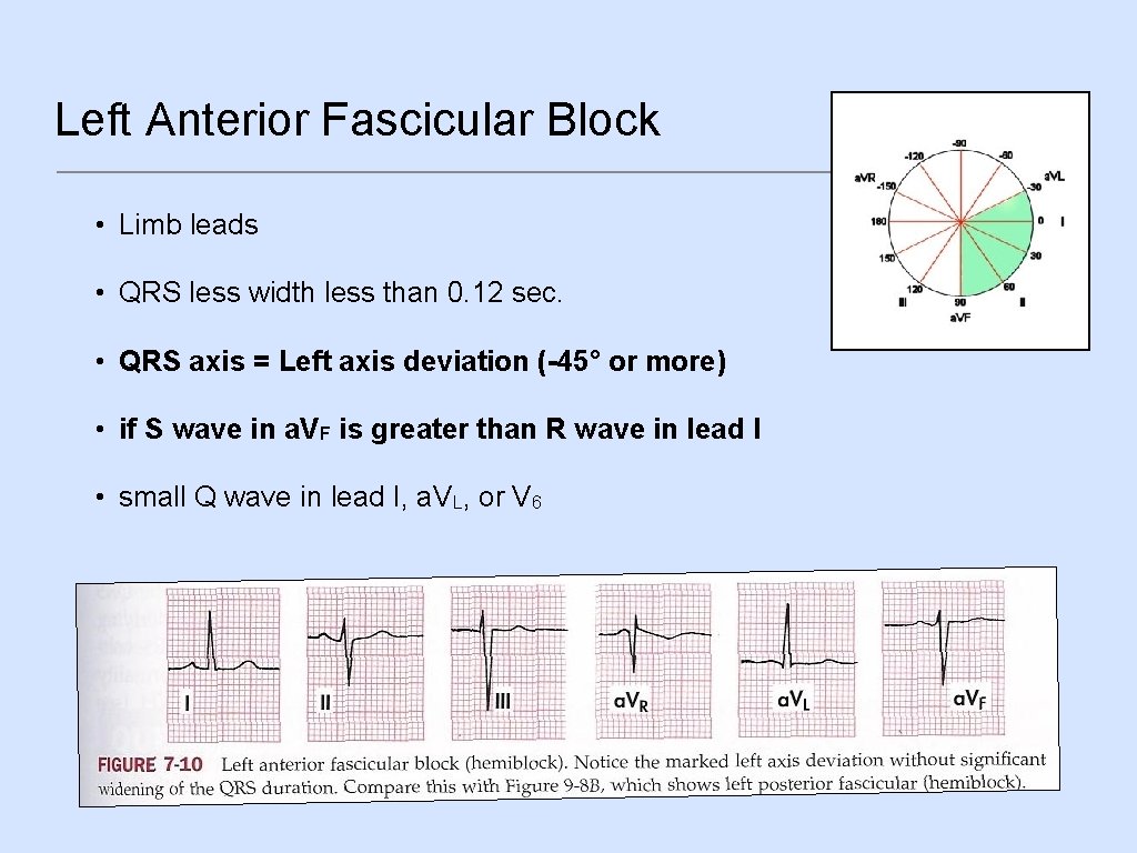 Left Anterior Fascicular Block • Limb leads • QRS less width less than 0.