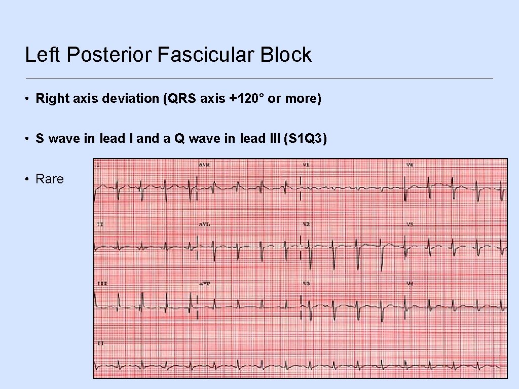 Left Posterior Fascicular Block • Right axis deviation (QRS axis +120° or more) •