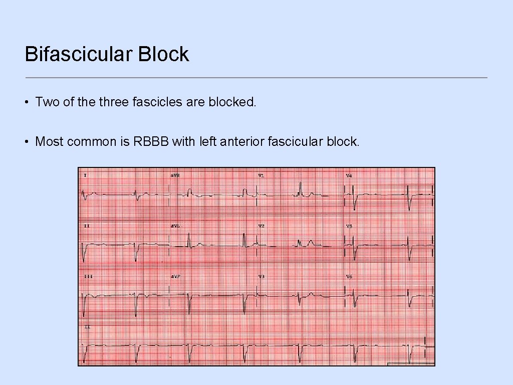 Bifascicular Block • Two of the three fascicles are blocked. • Most common is