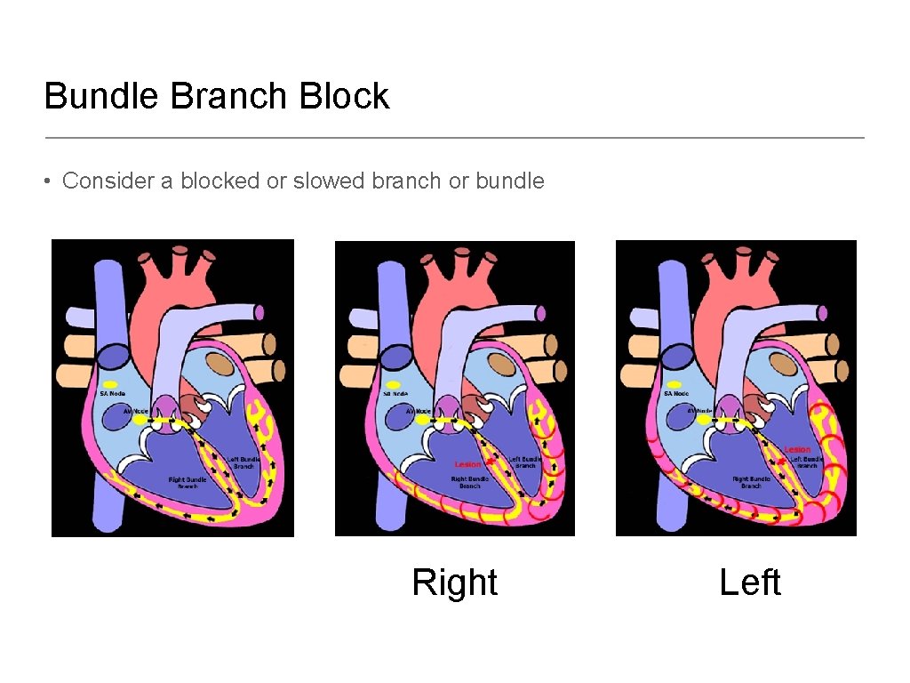 Bundle Branch Block • Consider a blocked or slowed branch or bundle Right Left