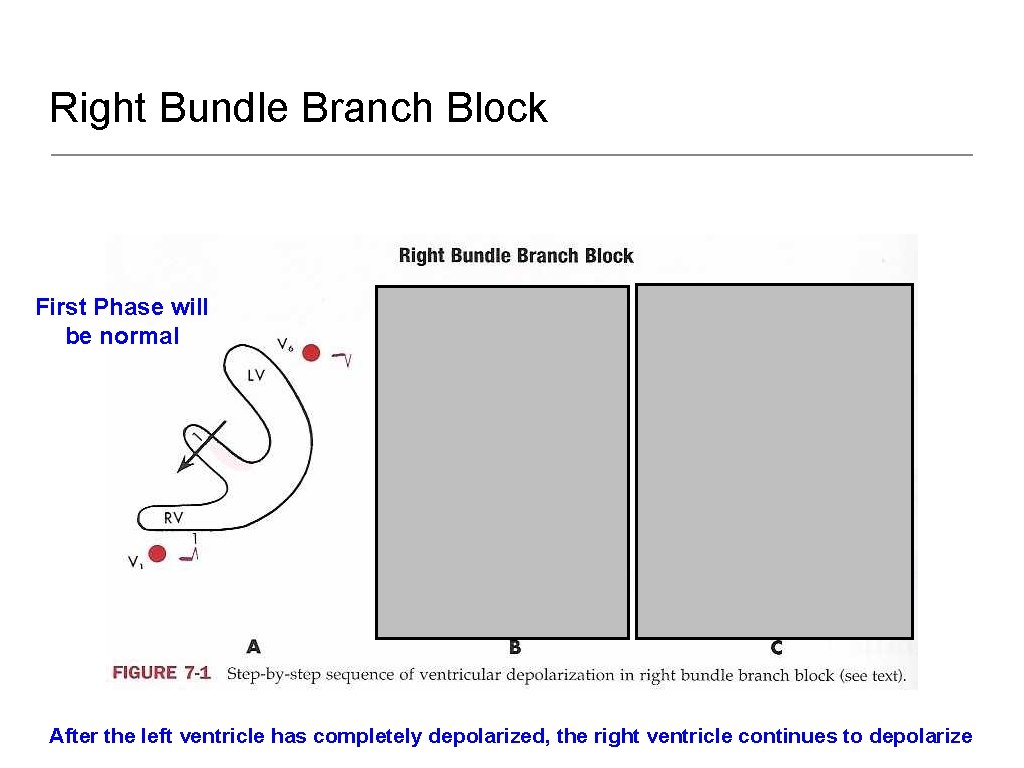 Right Bundle Branch Block First Phase will be normal Second Phase Normal Third Phase