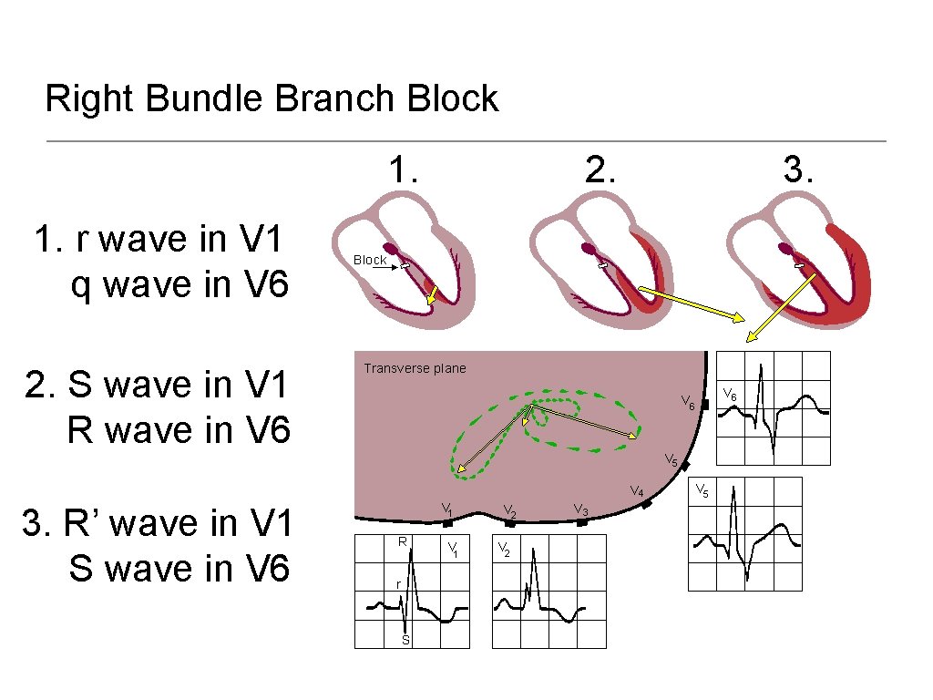 Right Bundle Branch Block 1. 1. r wave in V 1 q wave in