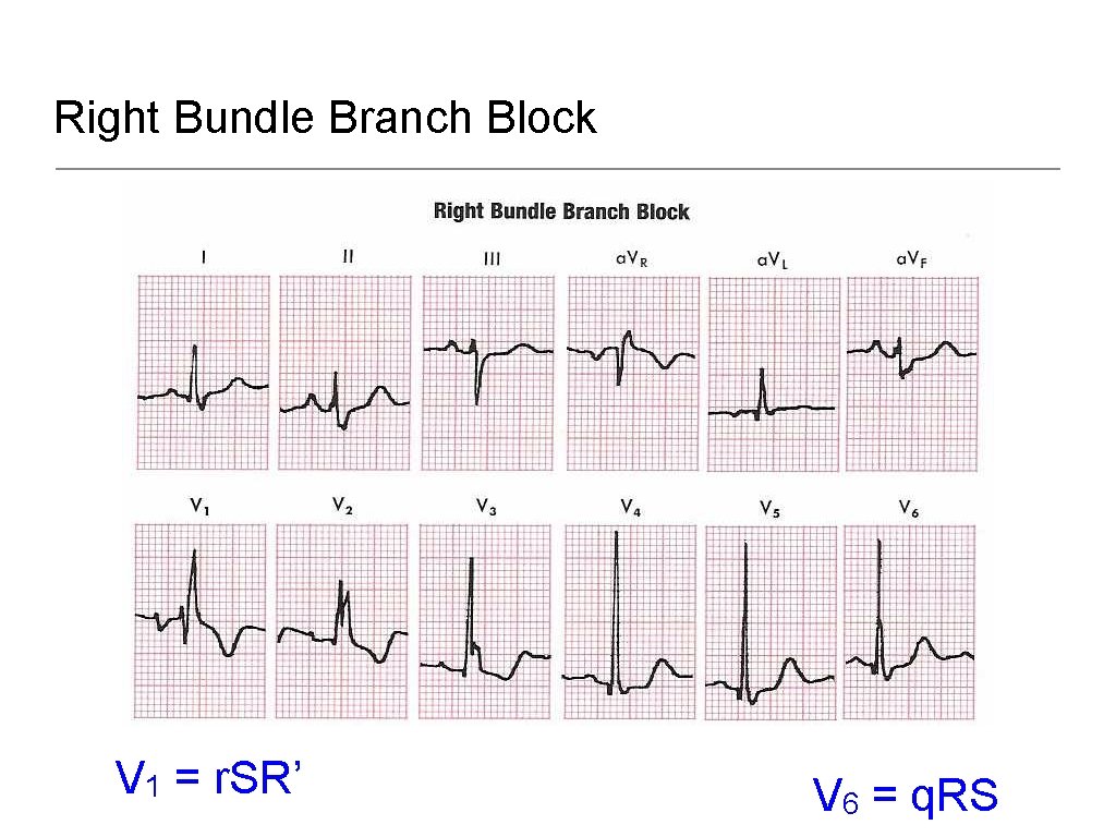Right Bundle Branch Block V 1 = r. SR’ V 6 = q. RS