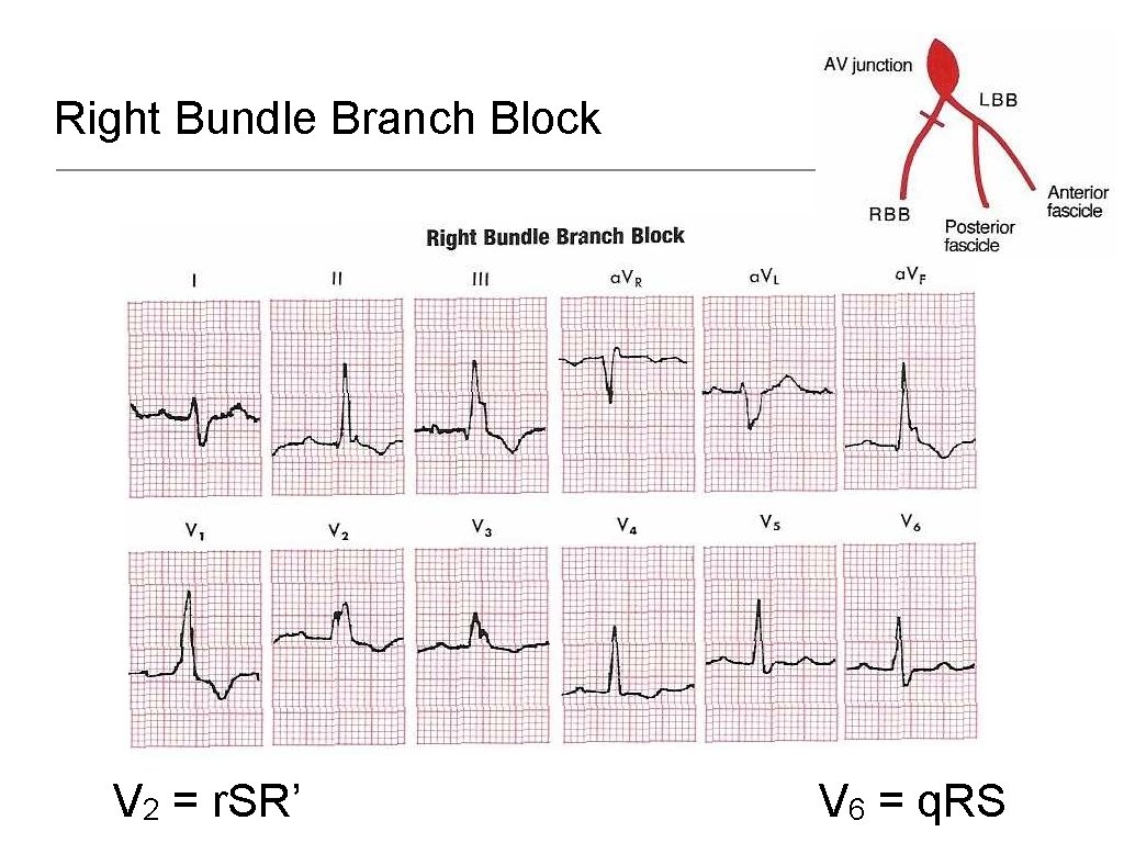 Right Bundle Branch Block V 2 = r. SR’ V 6 = q. RS