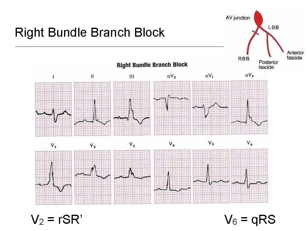 Right Bundle Branch Block V 2 = r. SR’ V 6 = q. RS