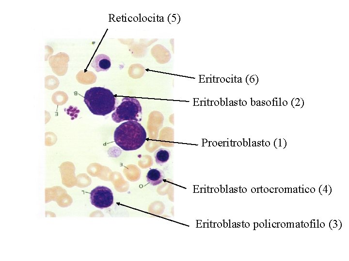 Reticolocita (5) Eritrocita (6) Eritroblasto basofilo (2) Proeritroblasto (1) Eritroblasto ortocromatico (4) Eritroblasto policromatofilo