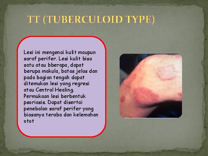 TT (TUBERCULOID TYPE) Lesi ini mengenai kulit maupun saraf perifer. Lesi kulit bisa satu