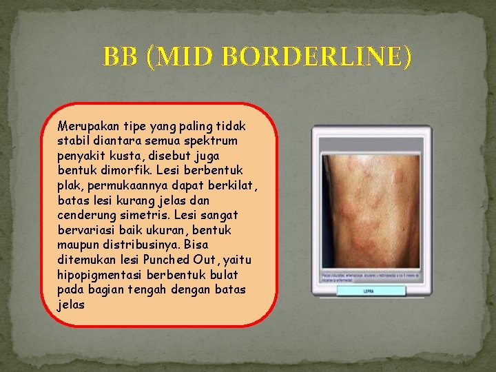 BB (MID BORDERLINE) Merupakan tipe yang paling tidak stabil diantara semua spektrum penyakit kusta, BB (MID BORDERLINE) Merupakan tipe yang paling tidak stabil diantara semua spektrum penyakit kusta,