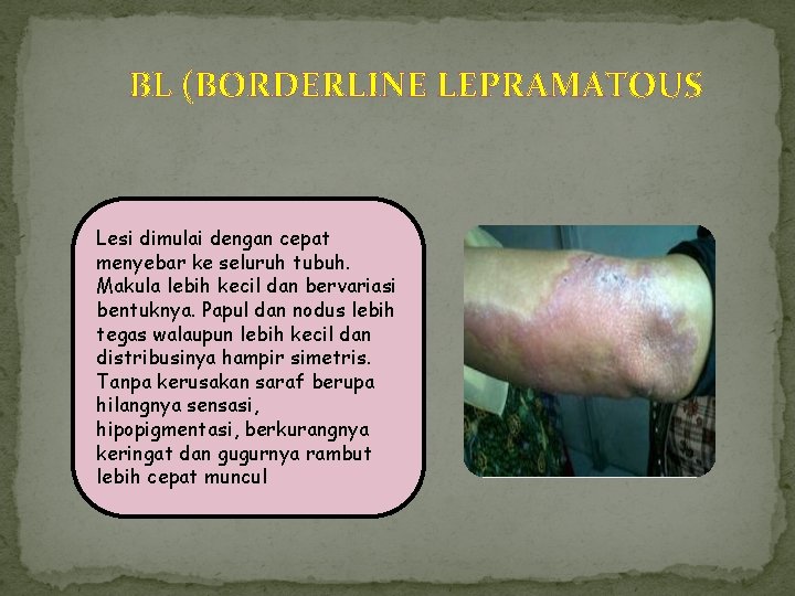 BL (BORDERLINE LEPRAMATOUS Lesi dimulai dengan cepat menyebar ke seluruh tubuh. Makula lebih kecil BL (BORDERLINE LEPRAMATOUS Lesi dimulai dengan cepat menyebar ke seluruh tubuh. Makula lebih kecil