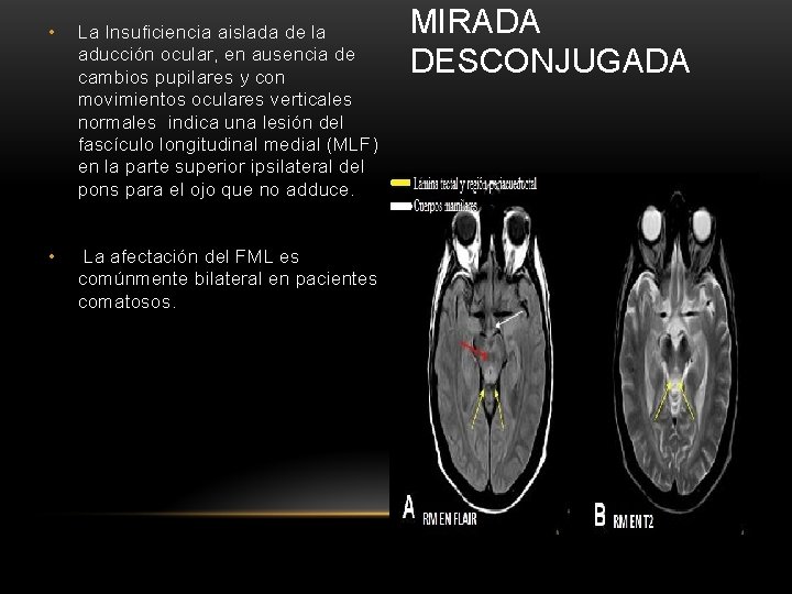  • La Insuficiencia aislada de la aducción ocular, en ausencia de cambios pupilares