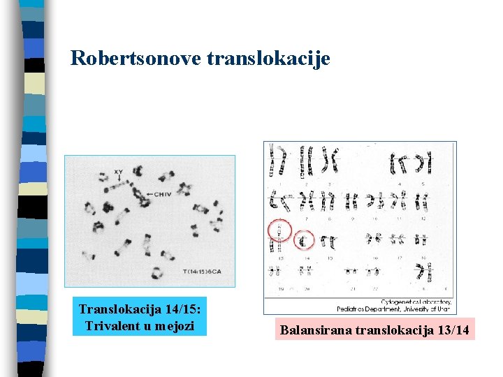 Robertsonove translokacije Translokacija 14/15: Trivalent u mejozi Balansirana translokacija 13/14 