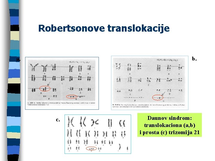 Robertsonove translokacije b. a. c. Daunov sindrom: translokaciona (a, b) i prosta (c) trizomija