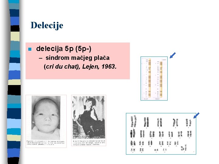 Delecije n delecija 5 p (5 p-) – sindrom mačjeg plača (cri du chat),