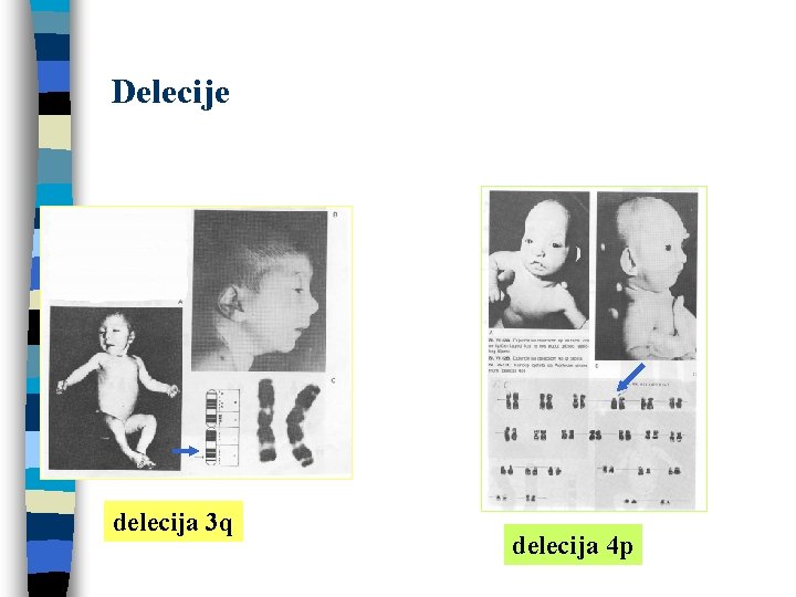 Delecije delecija 3 q delecija 4 p 